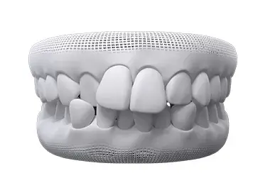 crowded teeth