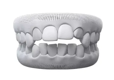 underbite