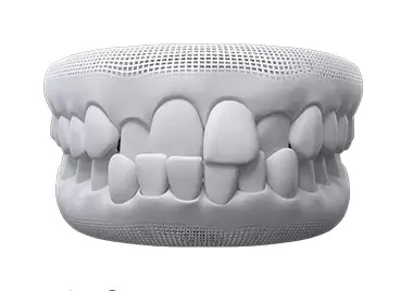 crossbite